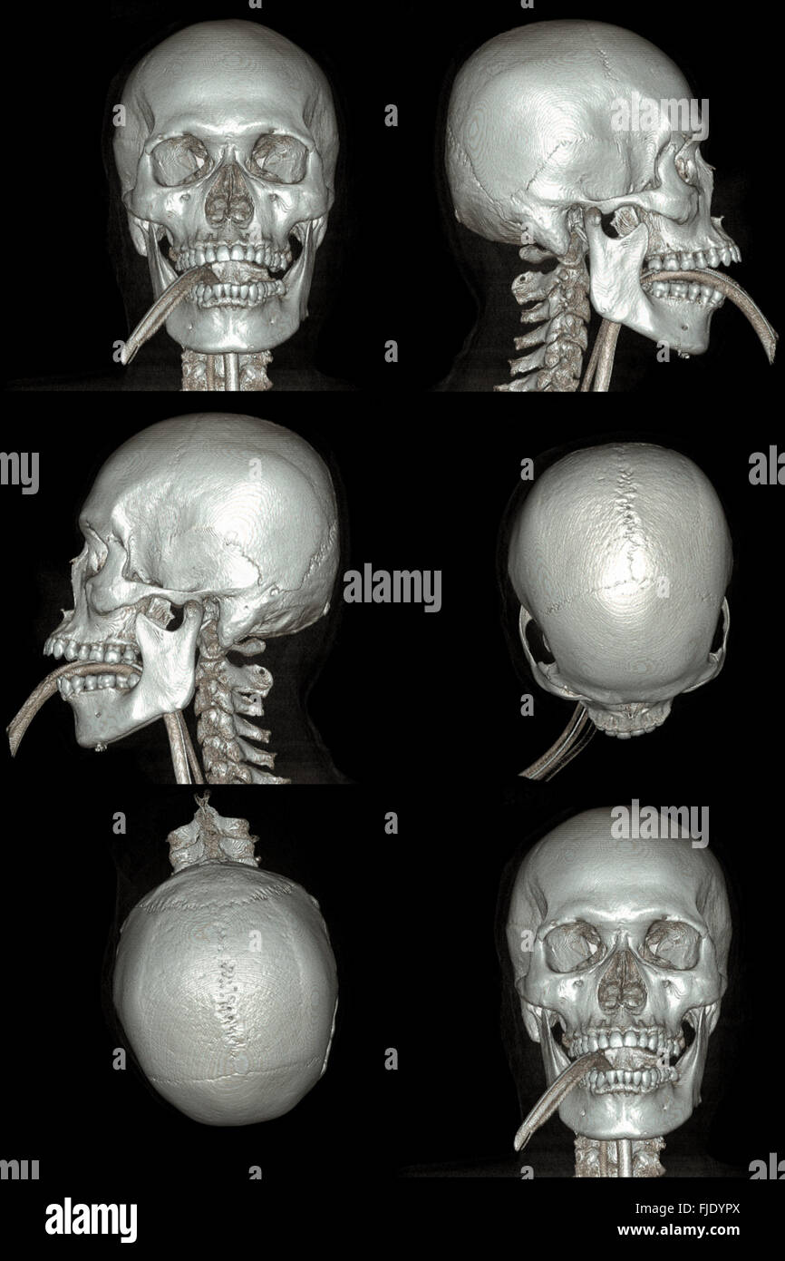 Röntgenbild des Schädels Computertomographie 3D Stockfoto