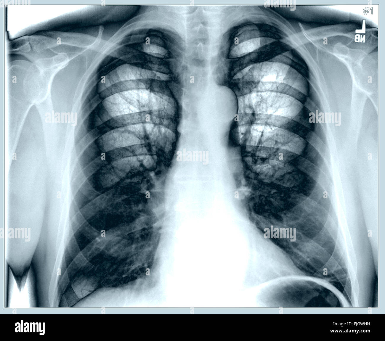 Männliche Brust-Gesundheit-Lunge Röntgen Stockfoto
