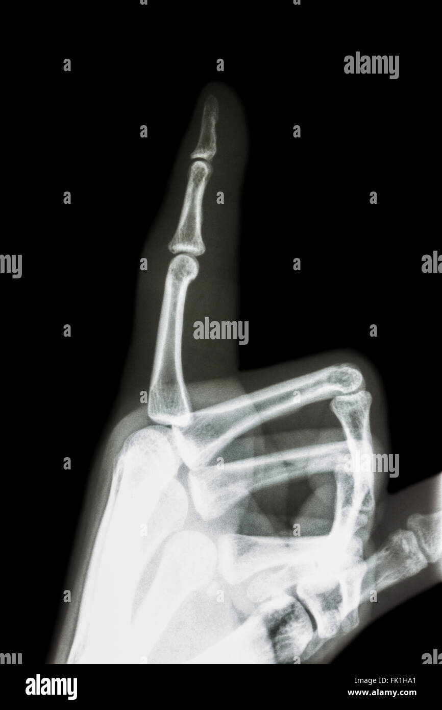 Film x-ray Zeigefinger und Hand (zeigen mit dem Finger) Stockfoto