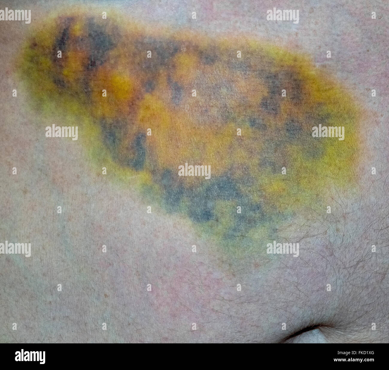 Hematoma under Fotos und Bildmaterial in hoher Auflösung Alamy