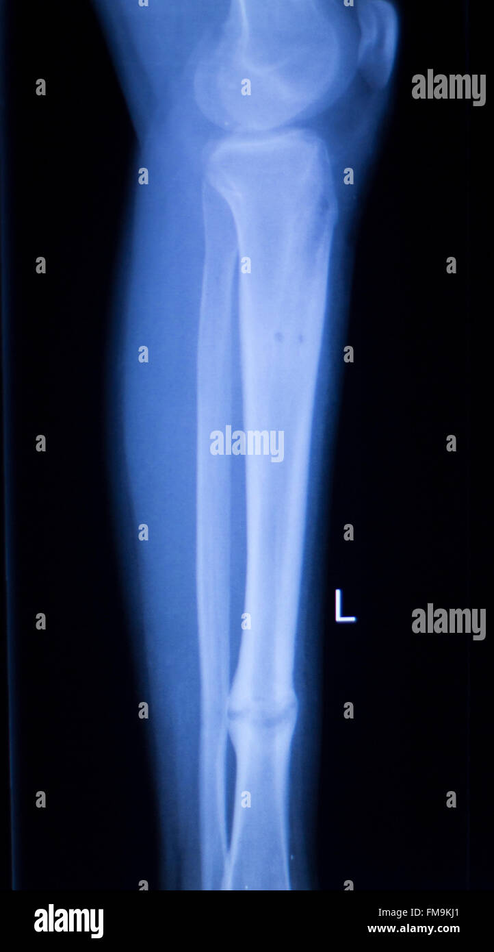 Unterarm, arm und Ellbogen Verletzungen Xray Scan Test Reults um Schmerzen Quelle zu
