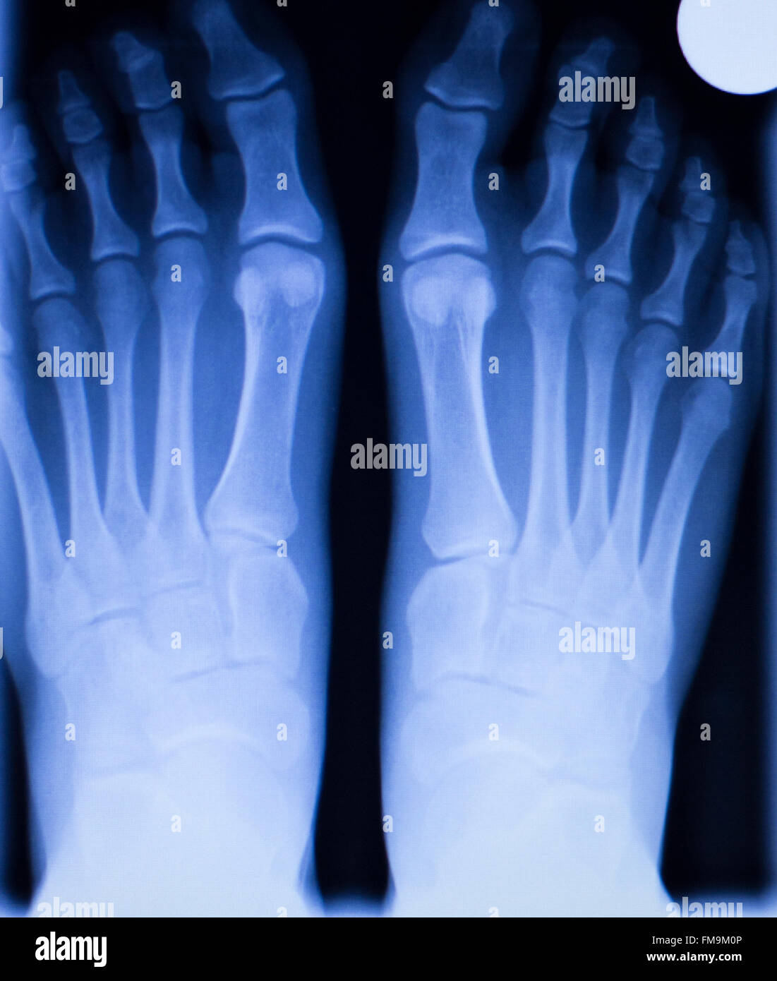 Fuß und Zehen Verletzung Traumatologie medizinische orthopädische Test ...