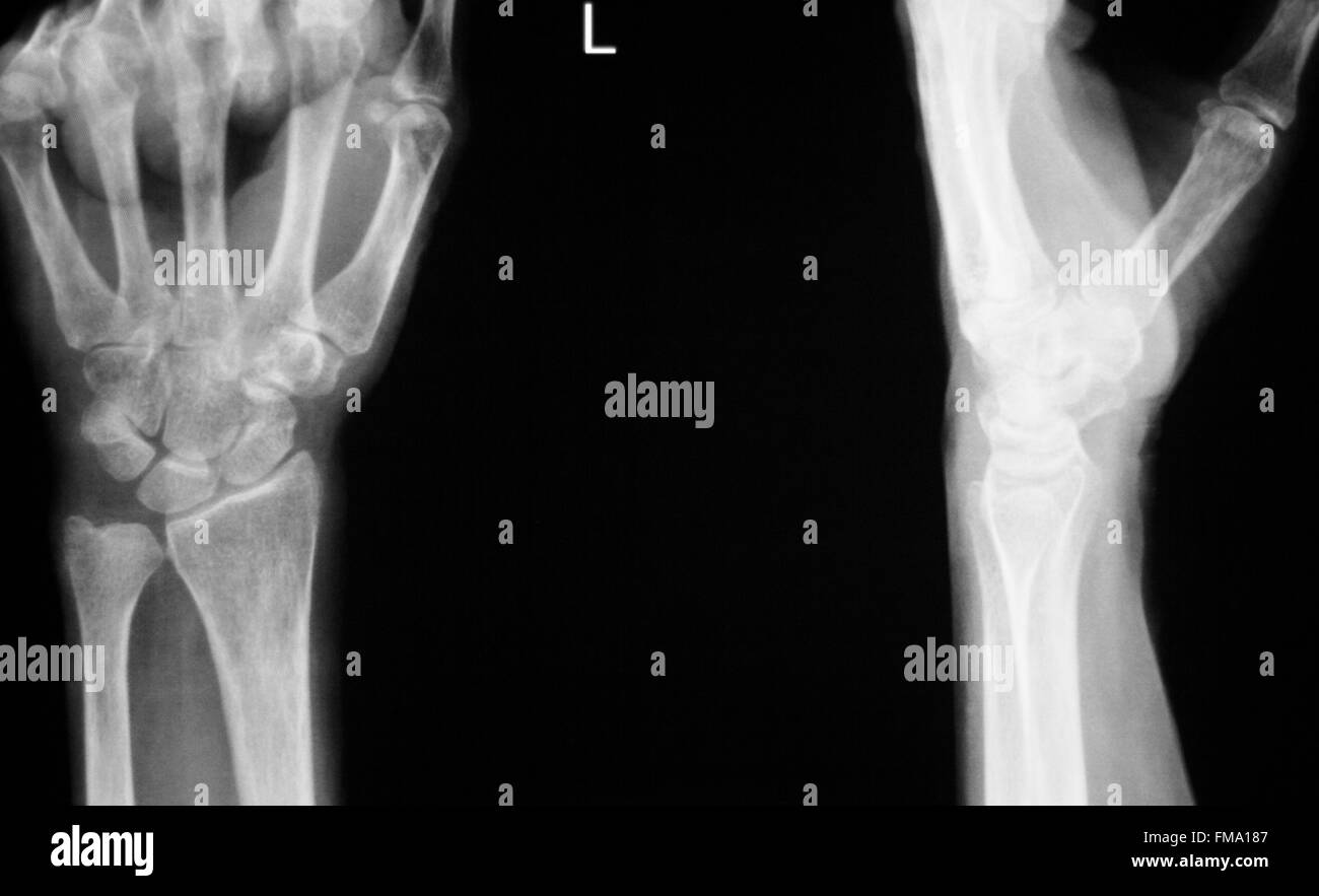 Hand, Finger, Daumen und Handgelenk Verletzungen orthopädische Traumatologie medizinischen Test Scan Röntgenbild. Stockfoto