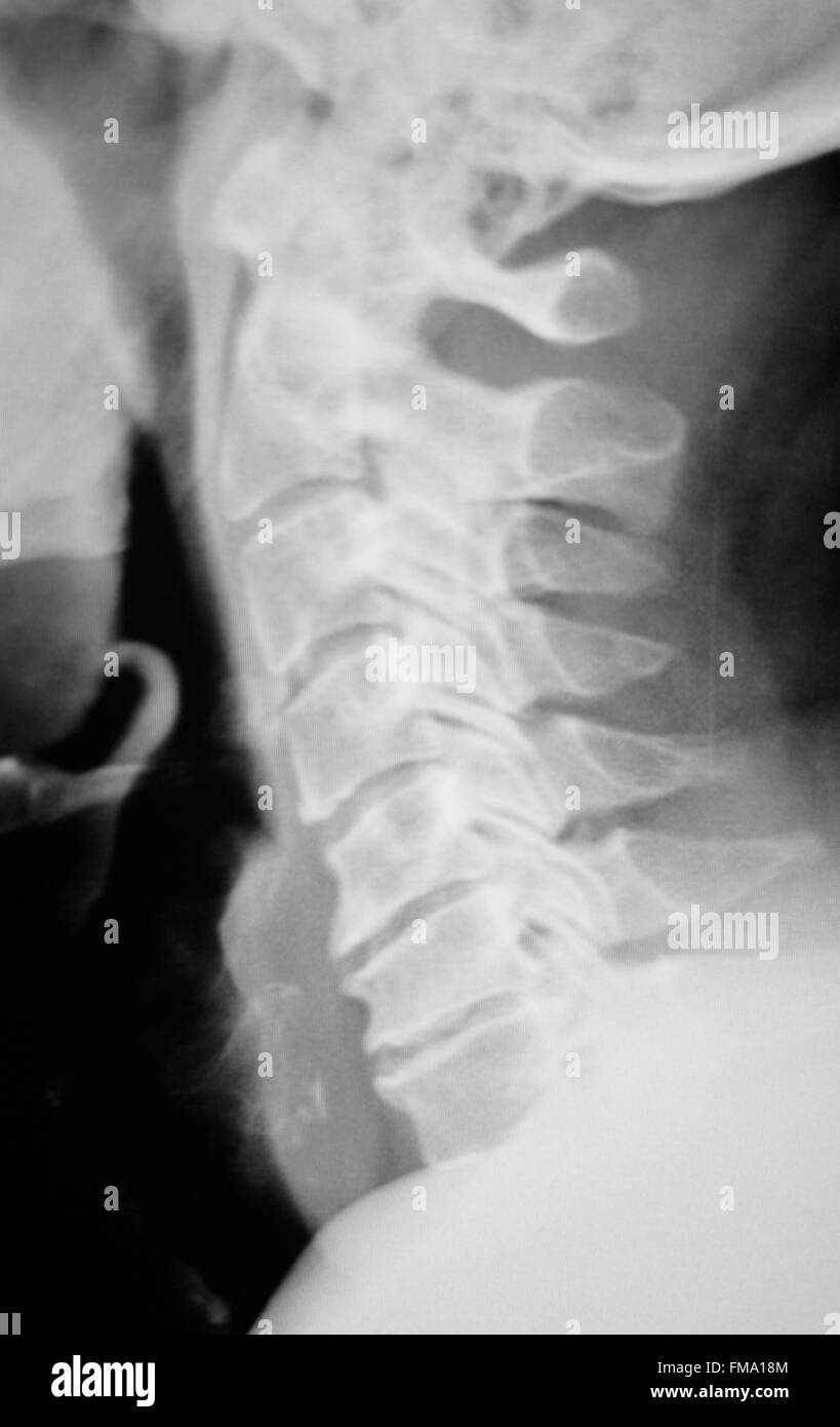 Schädel, Hals, Wirbelsäule, Wirbel und Schultern Verletzungen medizinischen Test Scan Röntgenbild. Stockfoto