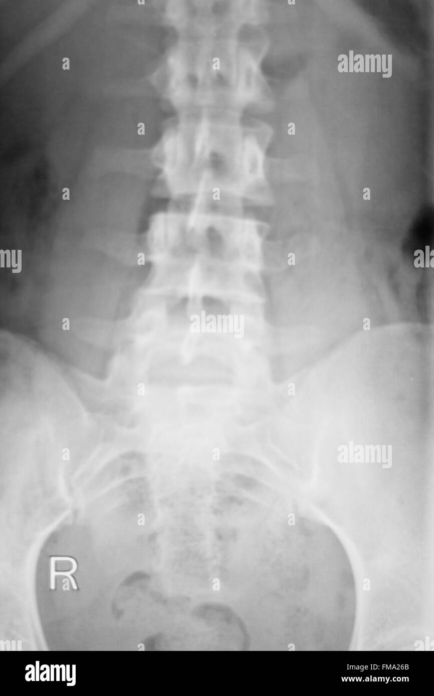 Wirbelsäule Wirbel Rückenverletzung Wirbelsäule medizinischen Test Scan Röntgenbild. Stockfoto