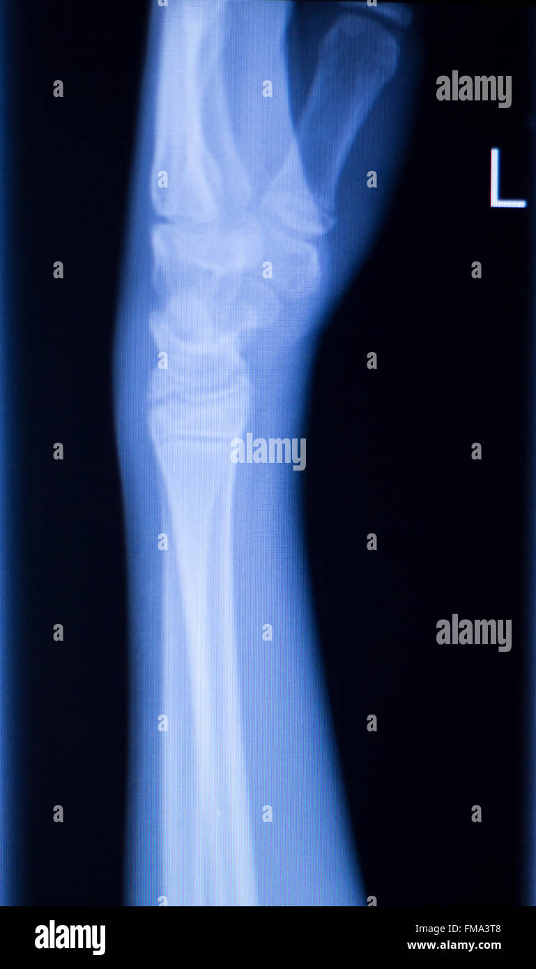 Unterarm, arm und Ellbogen Verletzungen Xray Scan Test Reults um Schmerzen Quelle zu diagnostizieren. Stockfoto