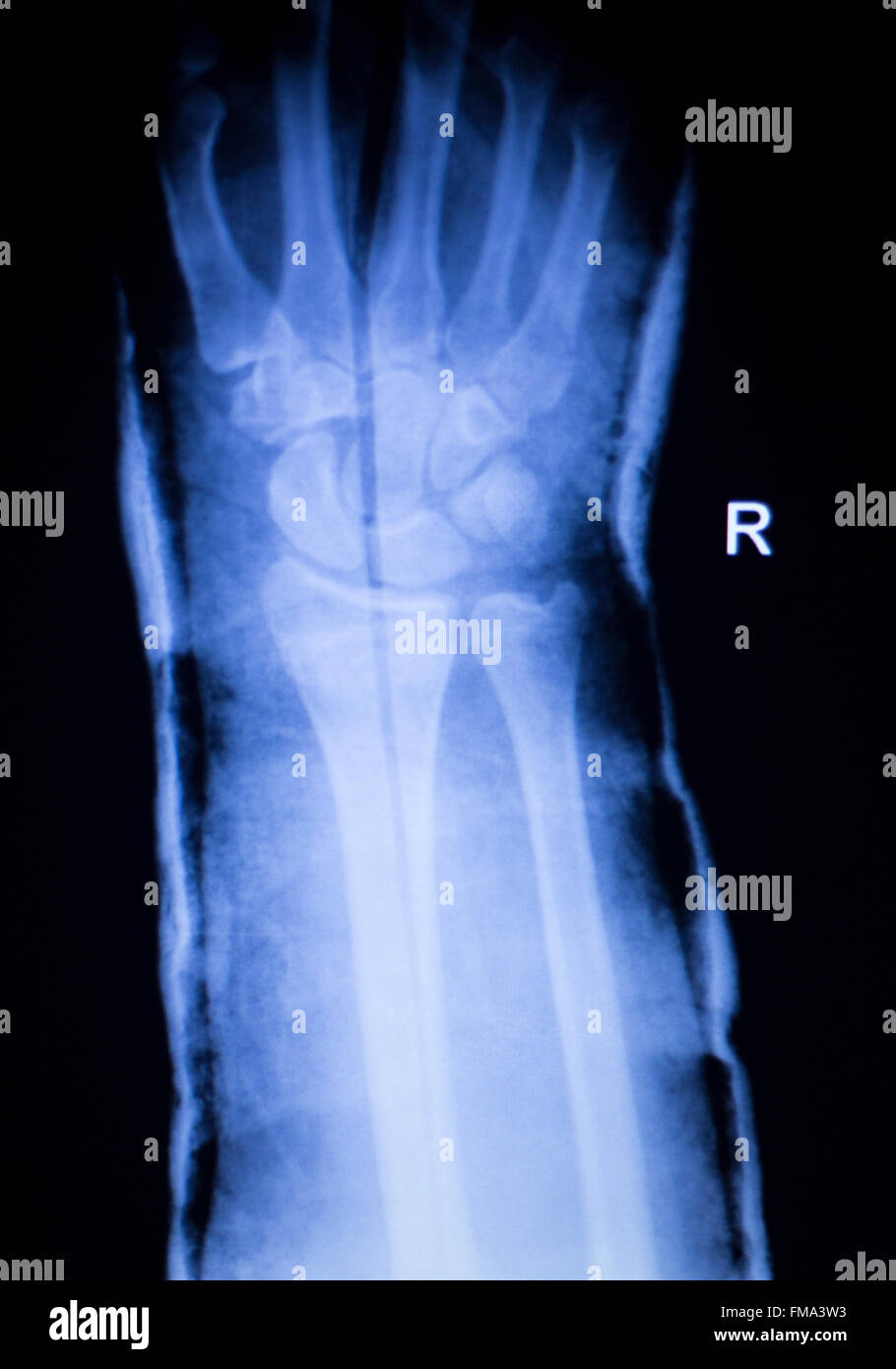 Arm, Unterarm und Handgelenk Verletzungen Xray Scan Test Reults Quelle der Schmerzen zu