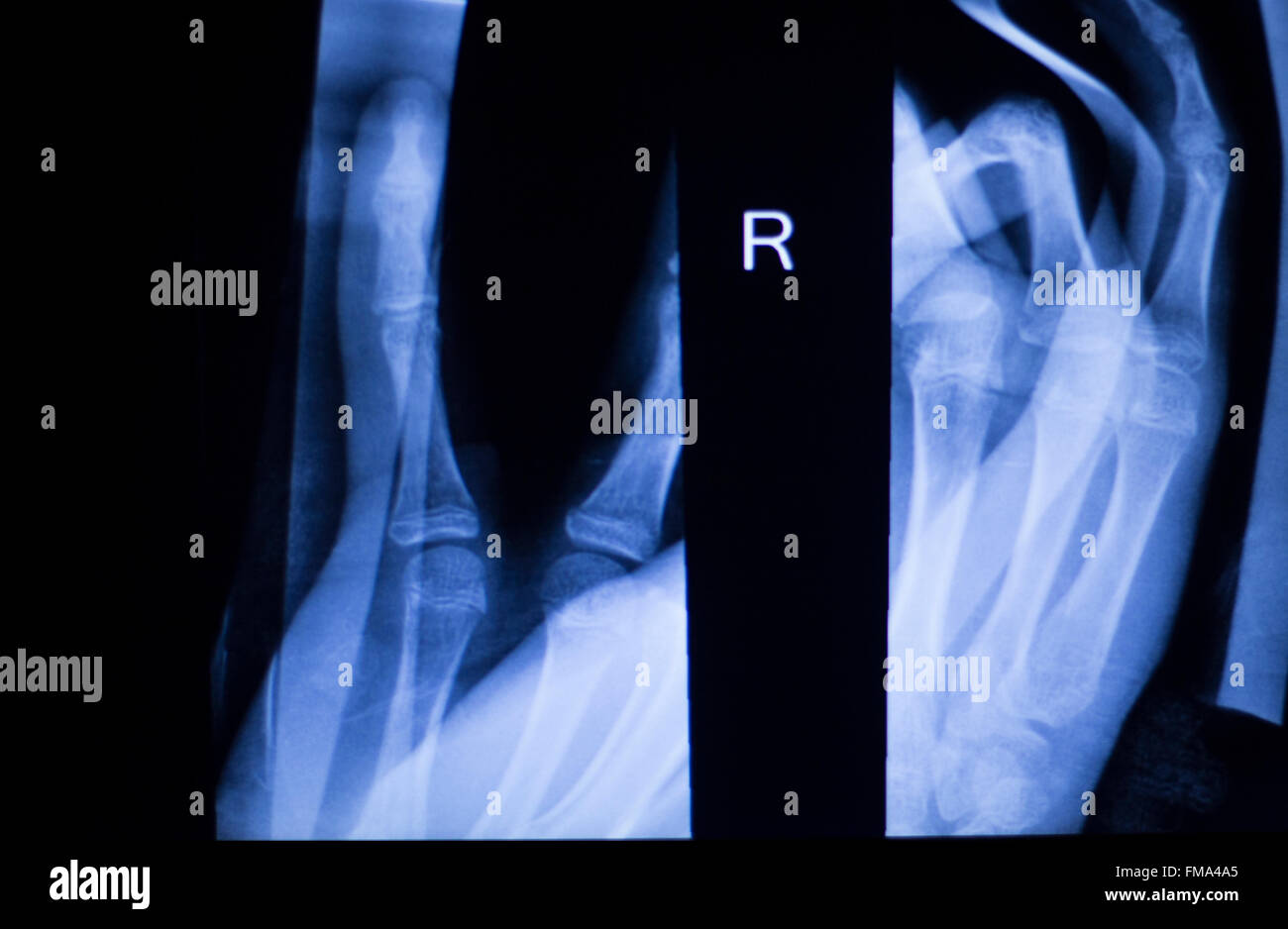 Unterarm, arm und Ellbogen Verletzungen Xray Scan Test Reults um Schmerzen Quelle zu diagnostizieren. Stockfoto