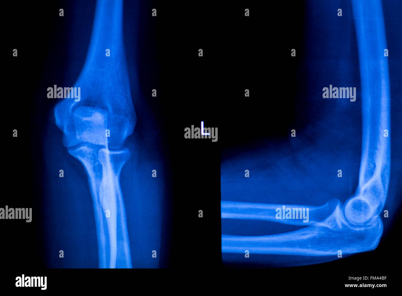 Unterarm, arm und Ellbogen Verletzungen Xray Scan Test Reults um Schmerzen Quelle zu diagnostizieren. Stockfoto