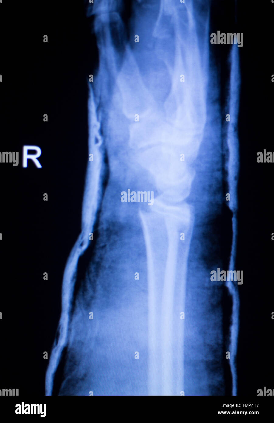Unterarm, arm und Ellbogen Verletzungen Xray Scan Test Reults um Schmerzen Quelle zu