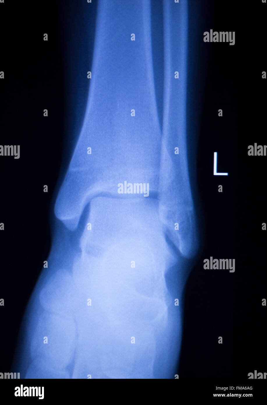 Unterarm, arm und Ellbogen Verletzungen Xray Scan Test Reults um Schmerzen Quelle zu