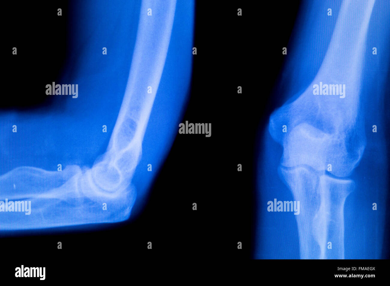 Unterarm, arm und Ellbogen Verletzungen Xray Scan Test Reults um Schmerzen Quelle zu