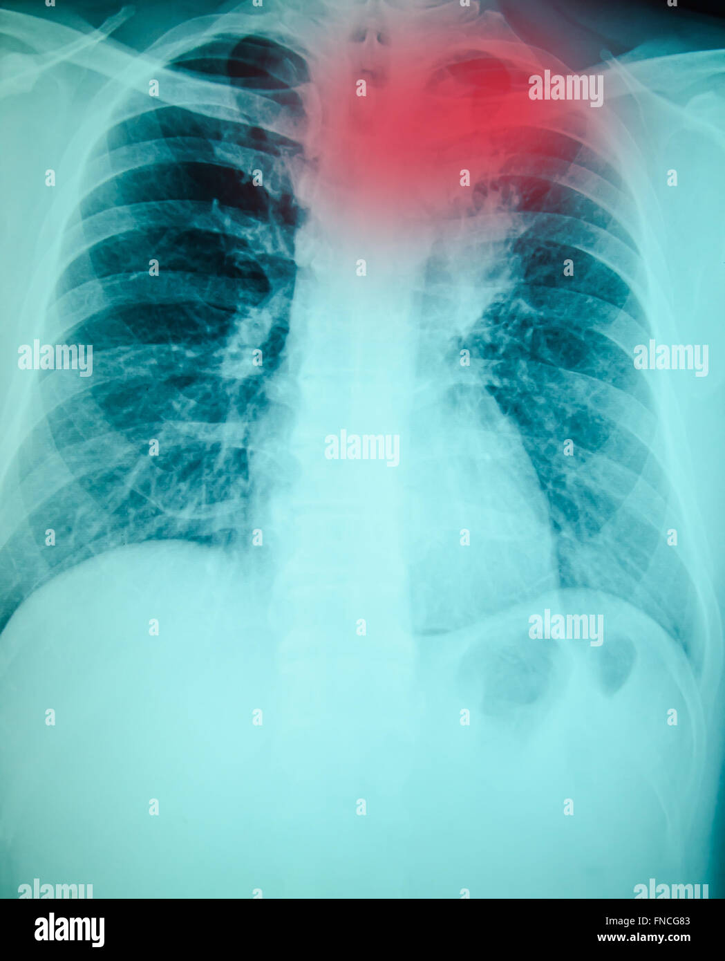 Röntgenuntersuchung der Brust für die Diagnose Stockfoto