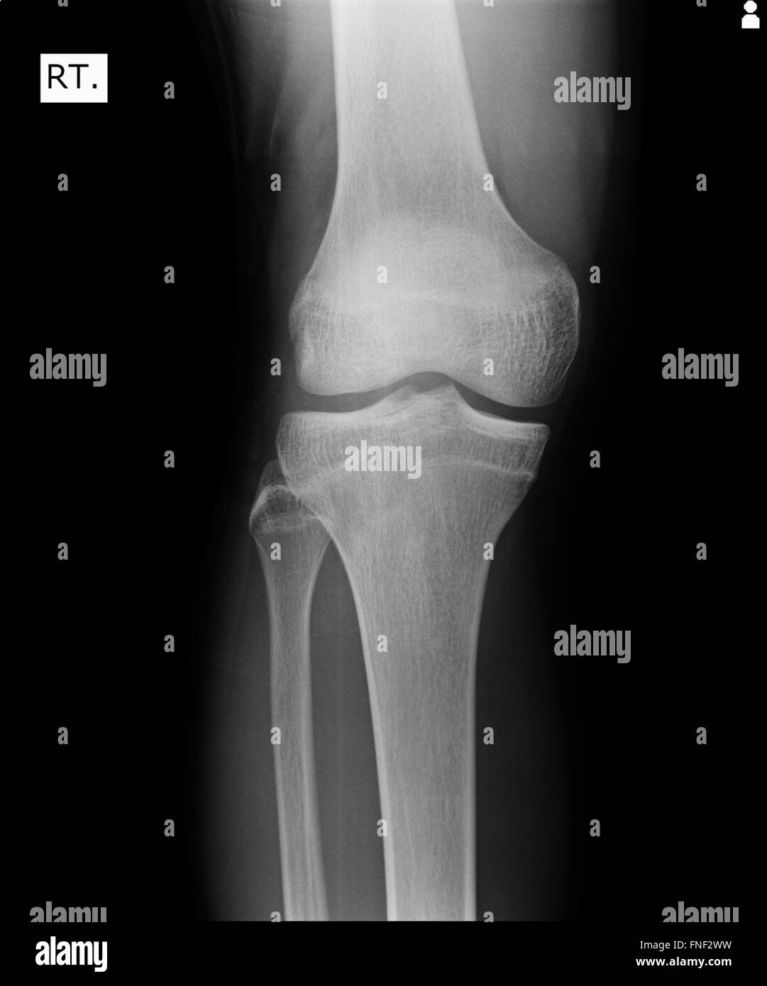 Knie mit Totalersatz Röntgenbild auf schwarzem Hintergrund Stockfoto