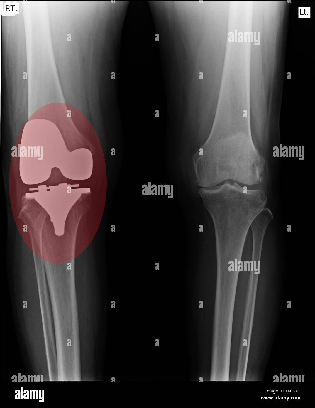 Knie mit Totalersatz Röntgenbild auf schwarzem Hintergrund Stockfoto