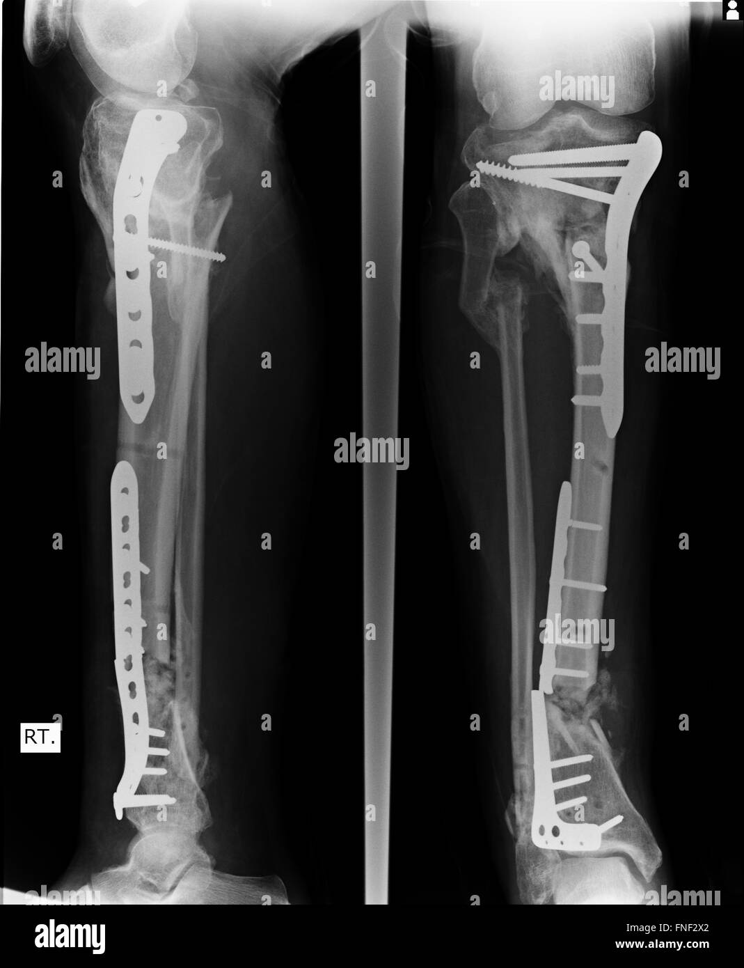 Bruch von Ellenbogen, Unterarm Röntgen Bild zeigt Platte und Schraube Befestigung Stockfoto