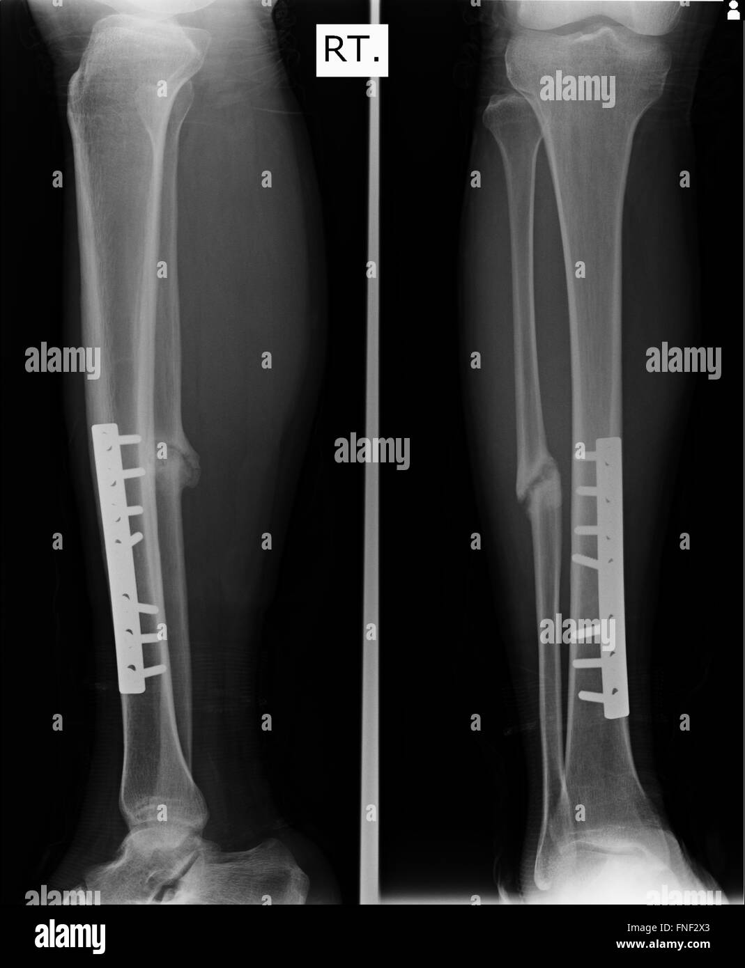 Bruch von Ellenbogen, Unterarm Röntgen Bild zeigt Platte und Schraube Befestigung Stockfoto