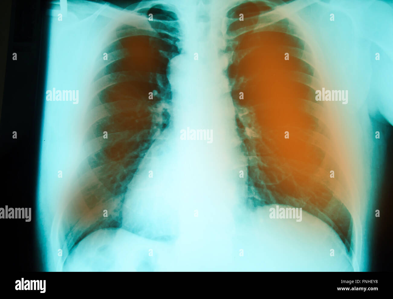 Röntgenuntersuchung der Brust zur Diagnostik pulmonaler Tuberkulose-Infektion mit beiden Lungen Stockfoto