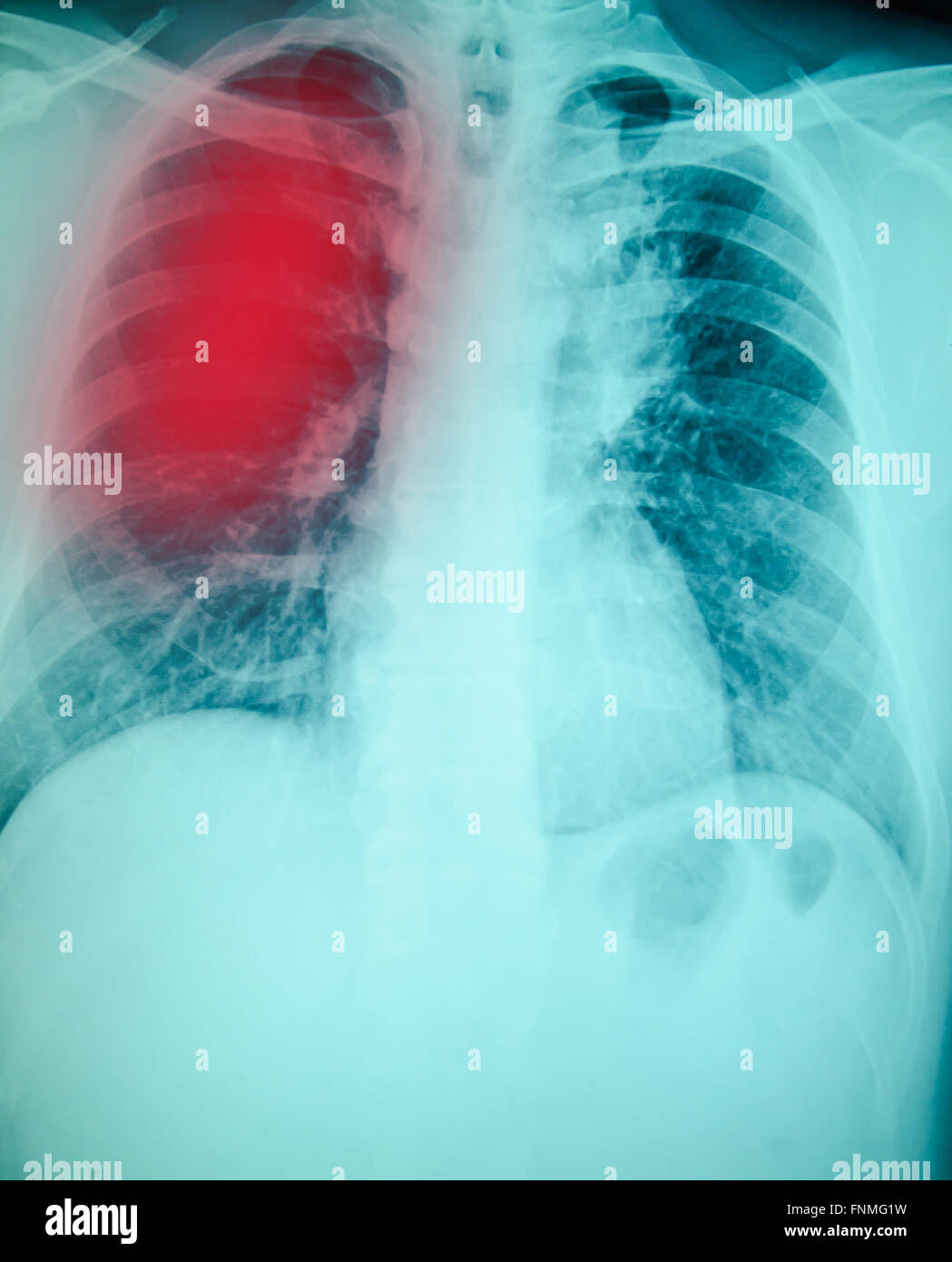 Röntgenuntersuchung der Brust für die Diagnose der Lungentuberkulose Infektion Stockfoto