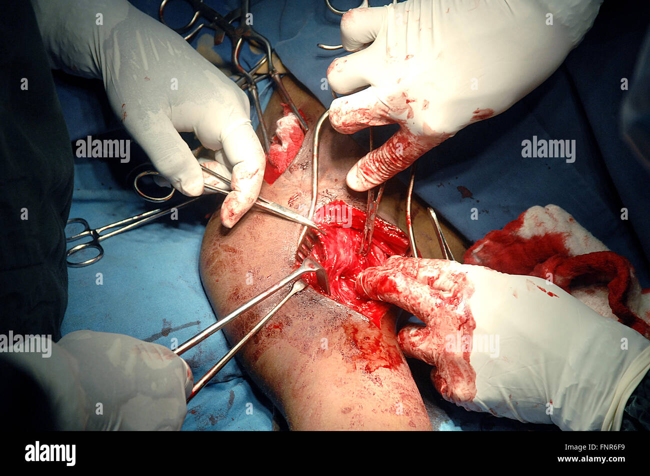 Nahaufnahme des Chirurgen durchführen eine axilläre Arterie Aneurysma um den Arm eines Teenagers zu reparieren, nachdem ein Stich an der Schulter verwundet. Stockfoto
