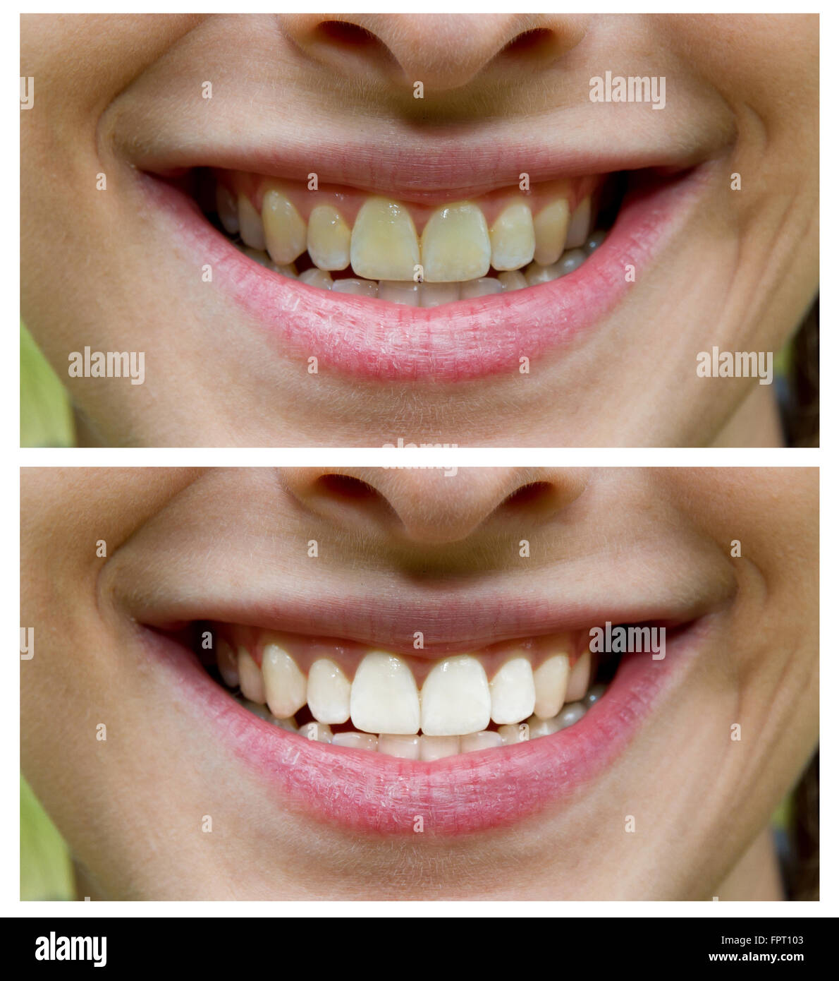 Zahnaufhellung - bleaching Behandlung Stockfoto
