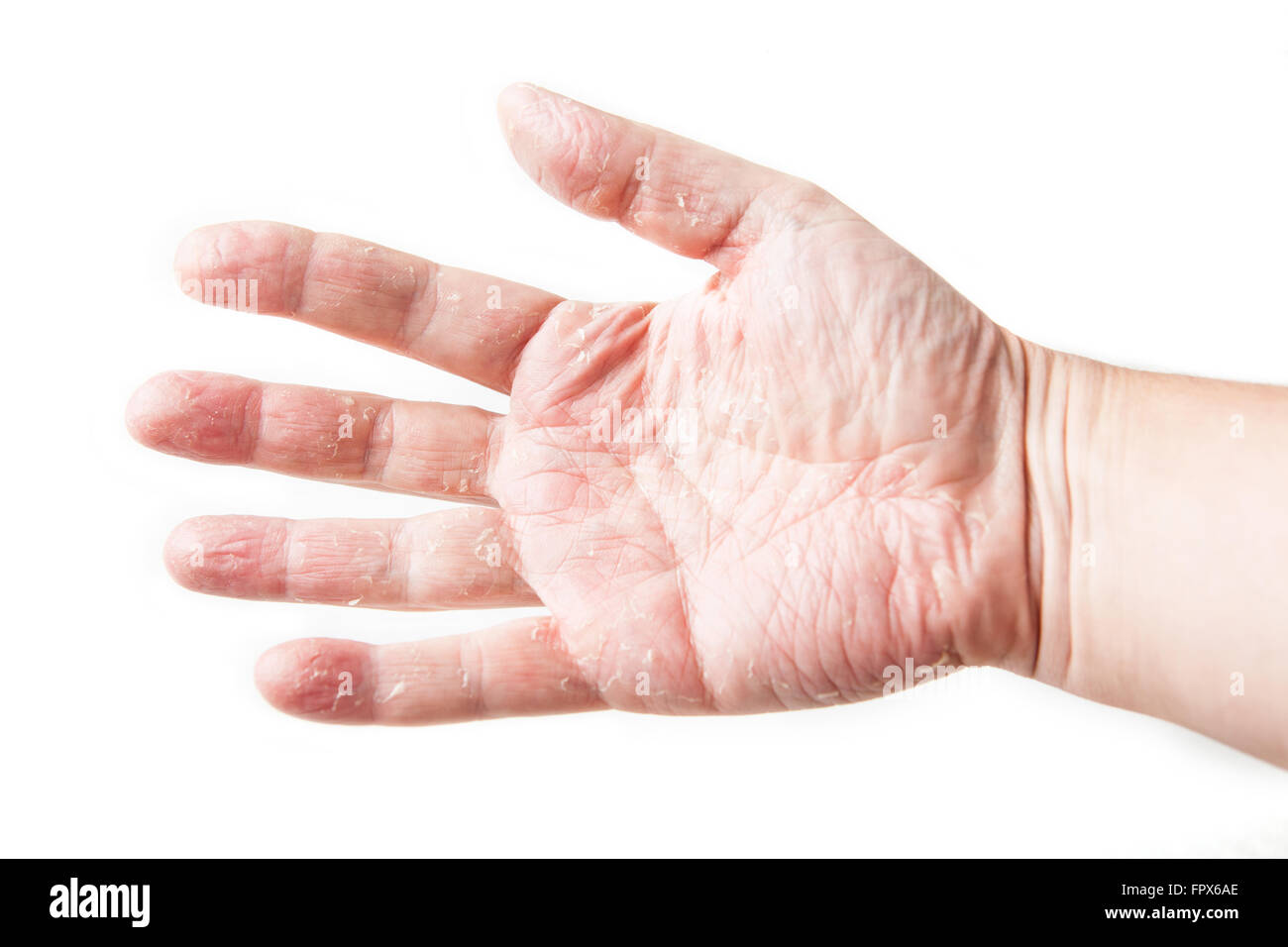 Hautkrankheit. Haut Allergie Epikutantest auf Rückseite des Patienten mit Rötung und Schwellung. Dermatitis Stockfoto