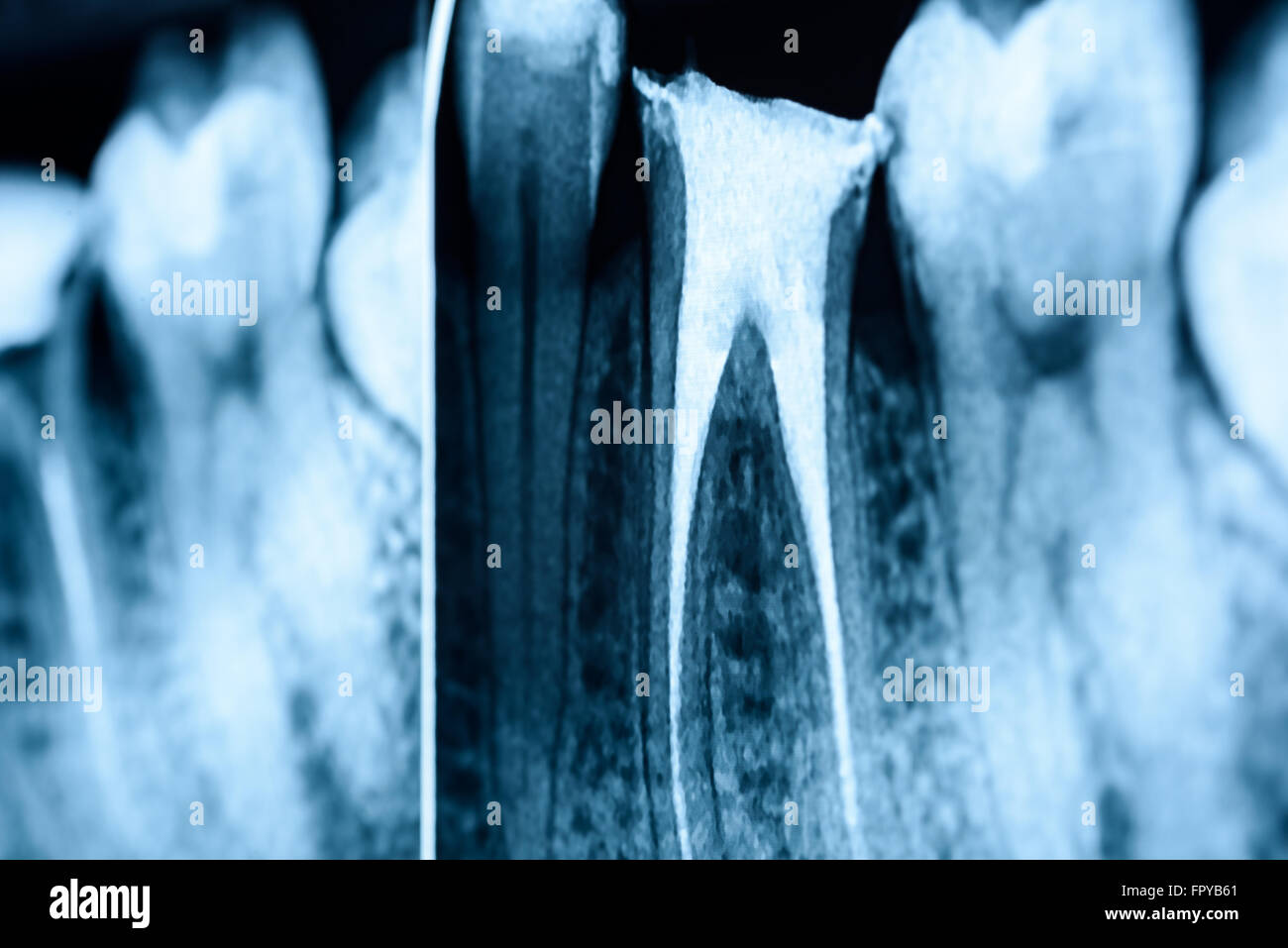 Volle Füllung des Wurzelkanals Systeme auf Zähne Röntgen Stockfoto
