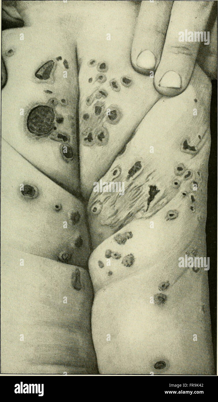 Recherche et diagnostische de l'hC3A9rC3A9do-Syphilis tardive (1907) Stockfoto