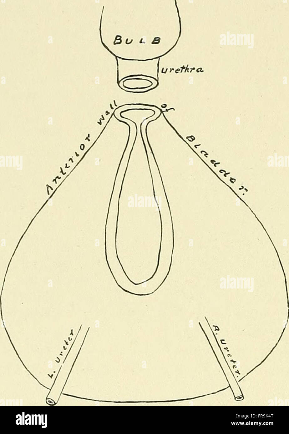 Studien zur Hypertrophie und Prostatakrebs (1906) Stockfoto