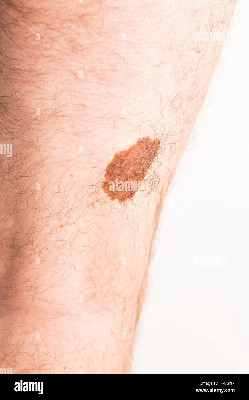 Melanom-Angiom-Beauty-Marke Stockfoto