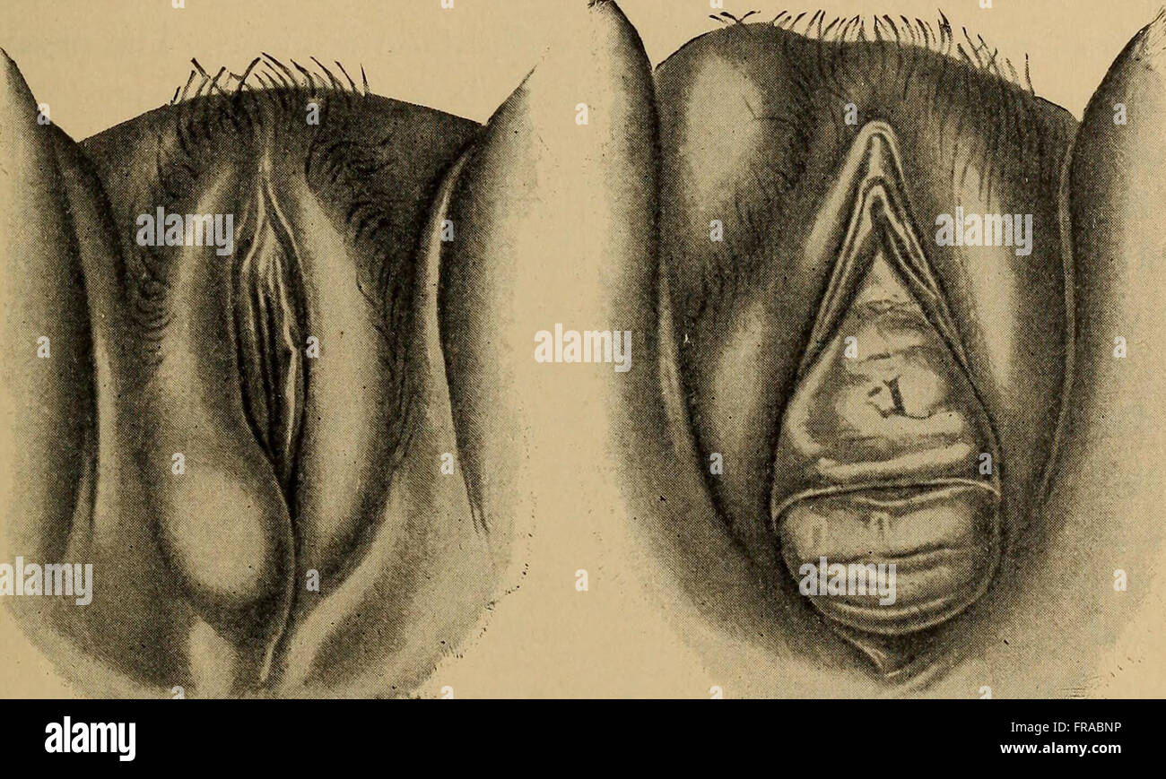 Diese 1905 Illustration, Teil eines medizinischen Buches, zeigt verschiedene Diagnosemethoden für Krankheiten von Frauen. Die detaillierten Skizzen und Diagramme spiegeln medizinische Praxen des frühen 20. Jahrhunderts wider und bieten Einblick in die historische Gesundheitsversorgung und Anatomie. Stockfoto