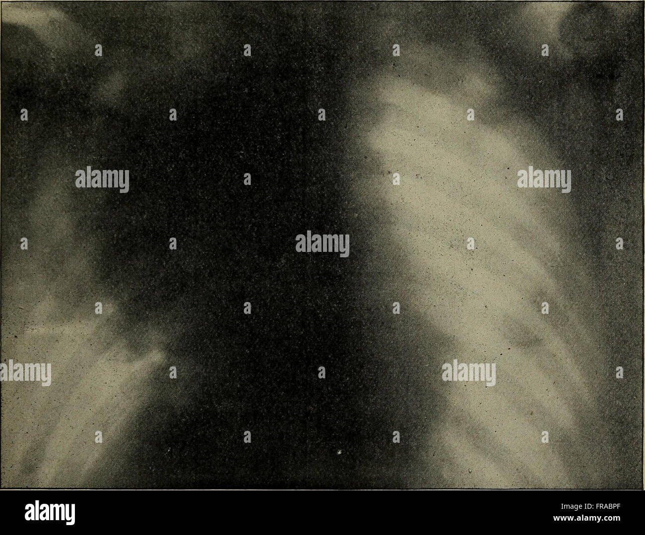 Die 1899 dargestellte Darstellung des Einsatzes von Röntgenstrahlen in der medizinischen Arbeit zeigt die frühe Anwendung dieser bahnbrechenden Technologie. Das Bild zeigt den historischen Moment des wissenschaftlichen Fortschritts und seine Auswirkungen auf die medizinische Diagnostik. Stockfoto
