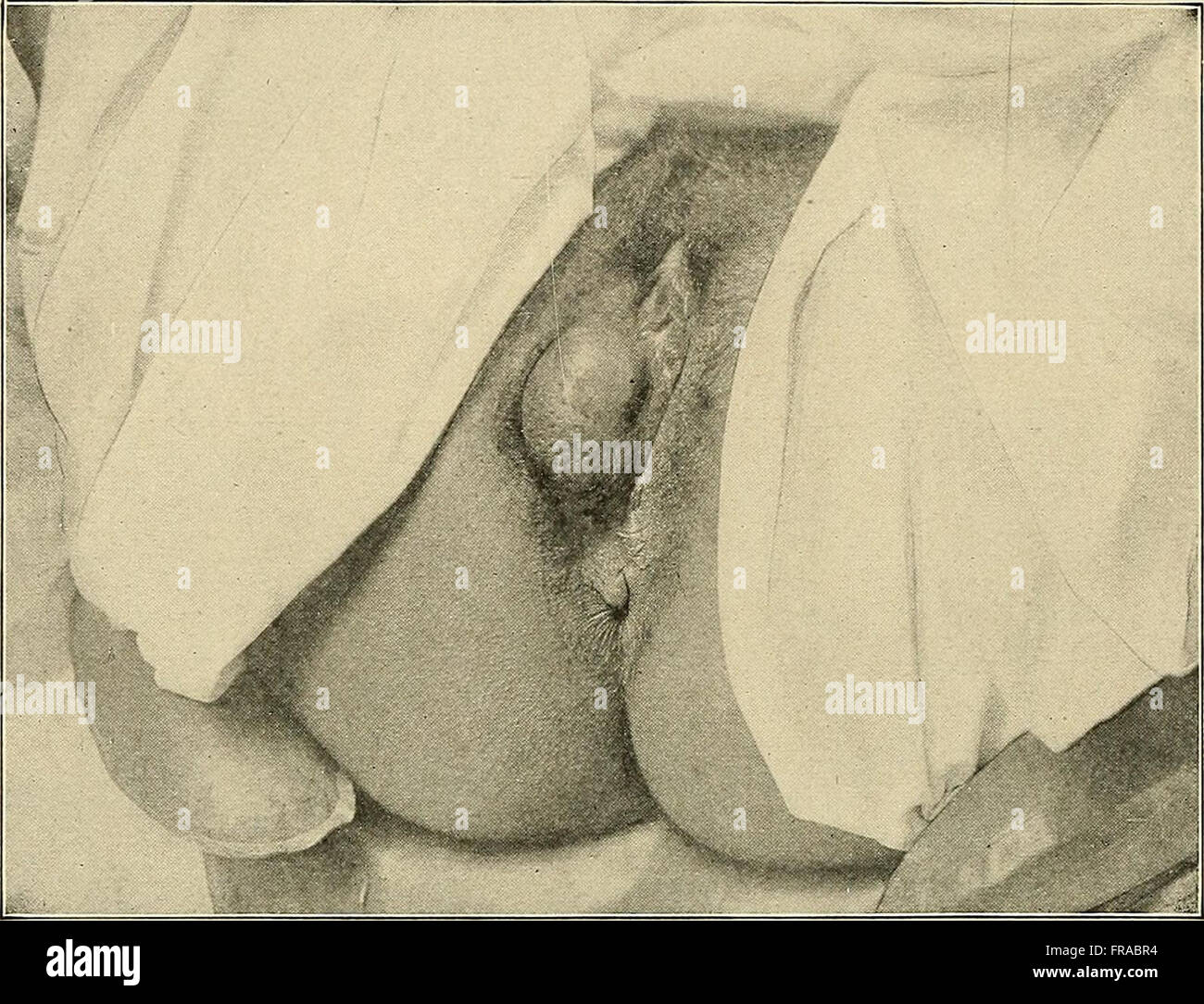 Diese 1907 Illustration aus einem historischen medizinischen Buch zeigt die Diagnose und Behandlung von Krankheiten, die Frauen im frühen 20. Jahrhundert betreffen. Es repräsentiert das medizinische Verständnis und die Praxis der Zeit. Stockfoto