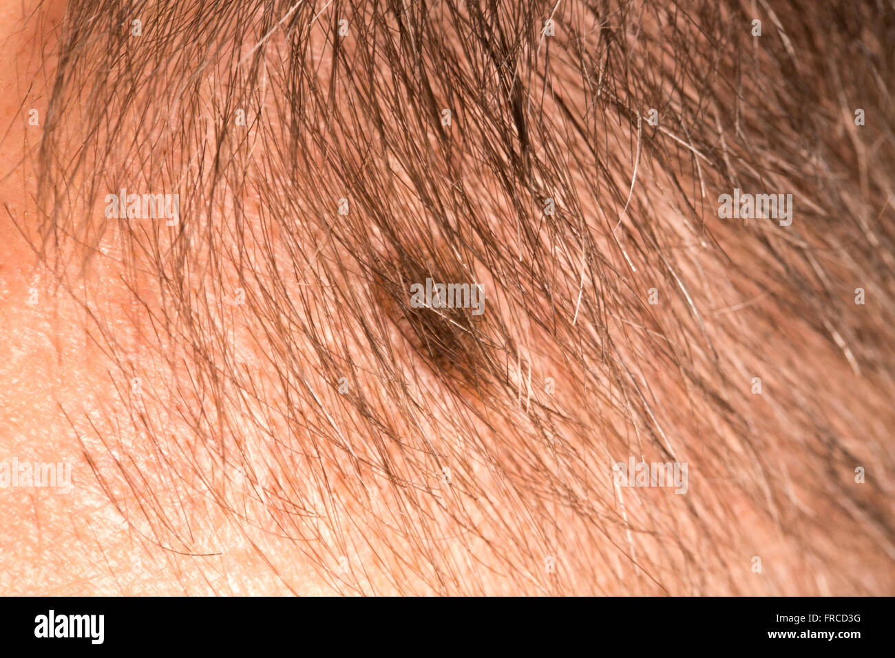 Naevus Gutartig Stockfotos und -bilder Kaufen - Alamy