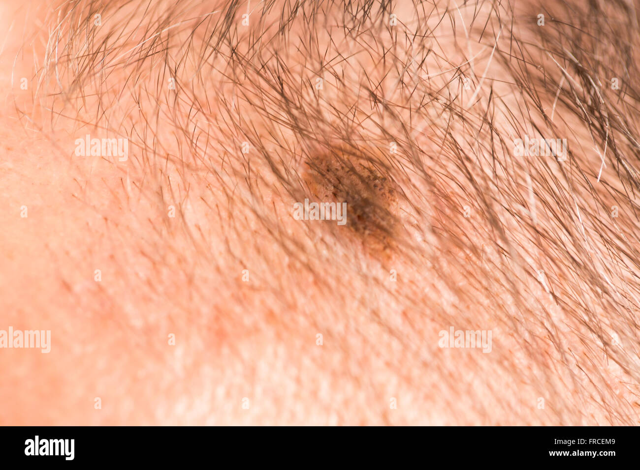 Melanom-Angiom-Beauty-Marke Stockfoto