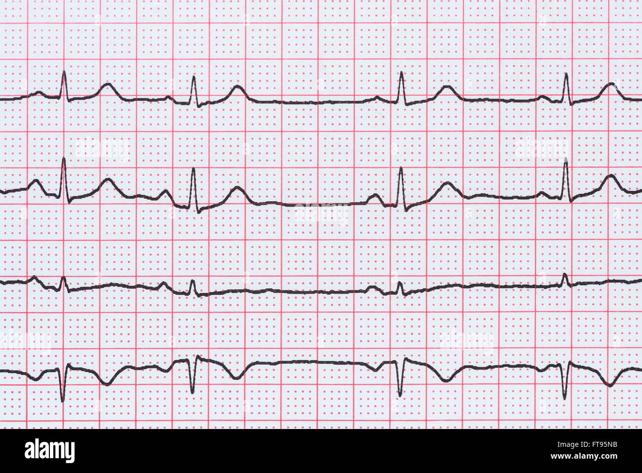 Sinusrhythmus Herz auf Elektrokardiogramm Rekord Papier zeigt normale P-Welle, PR und QT-Intervall und QRS-Komplex Stockfoto