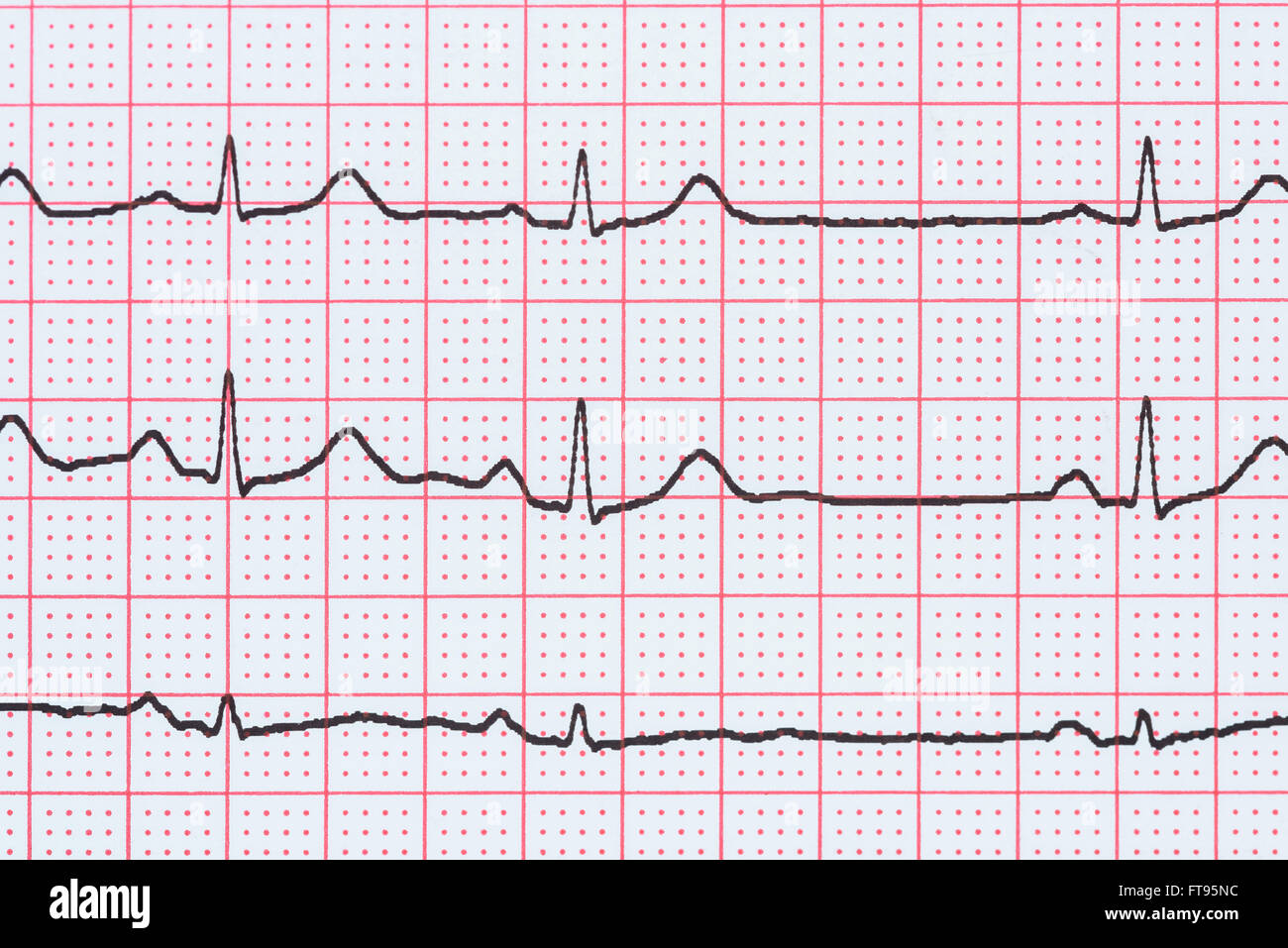 Sinusrhythmus Herz auf Elektrokardiogramm Rekord Papier zeigt normale P-Welle, PR und QT-Intervall und QRS-Komplex Stockfoto