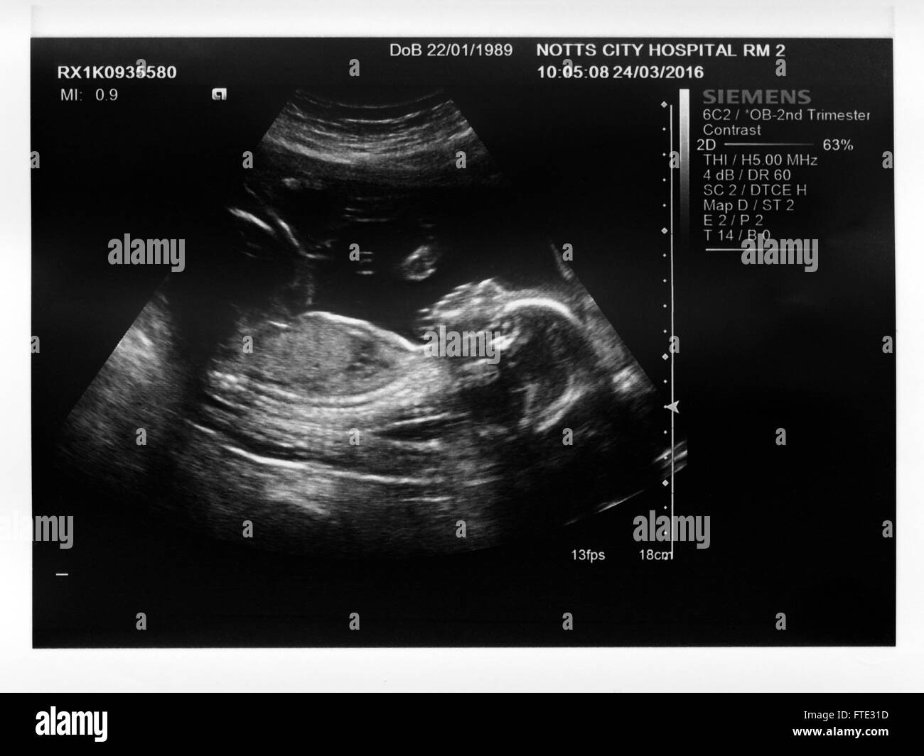 Ein 2. Trimester Baby Boy Ultraschalluntersuchung. (Mütter Name Digital entfernt) Stockfoto