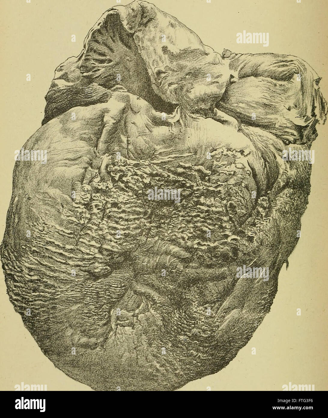 Krankheiten des Herzens und der thorakalen Aorta (1884) Stockfoto