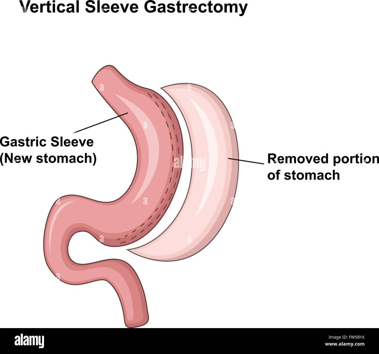 Illustration der vertikalen SleeveGastrektomie (VSG