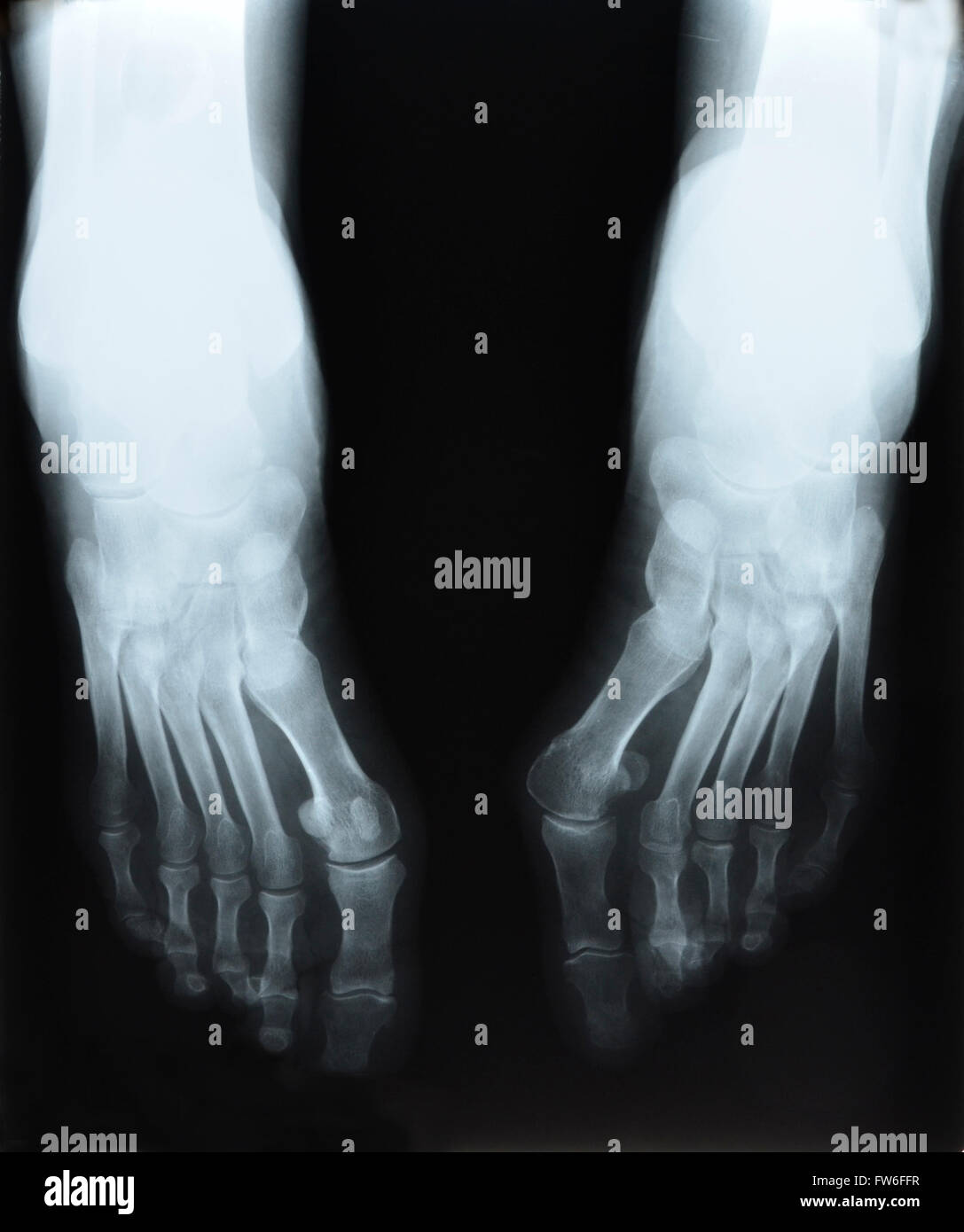 Röntgen des Fußes Stockfoto