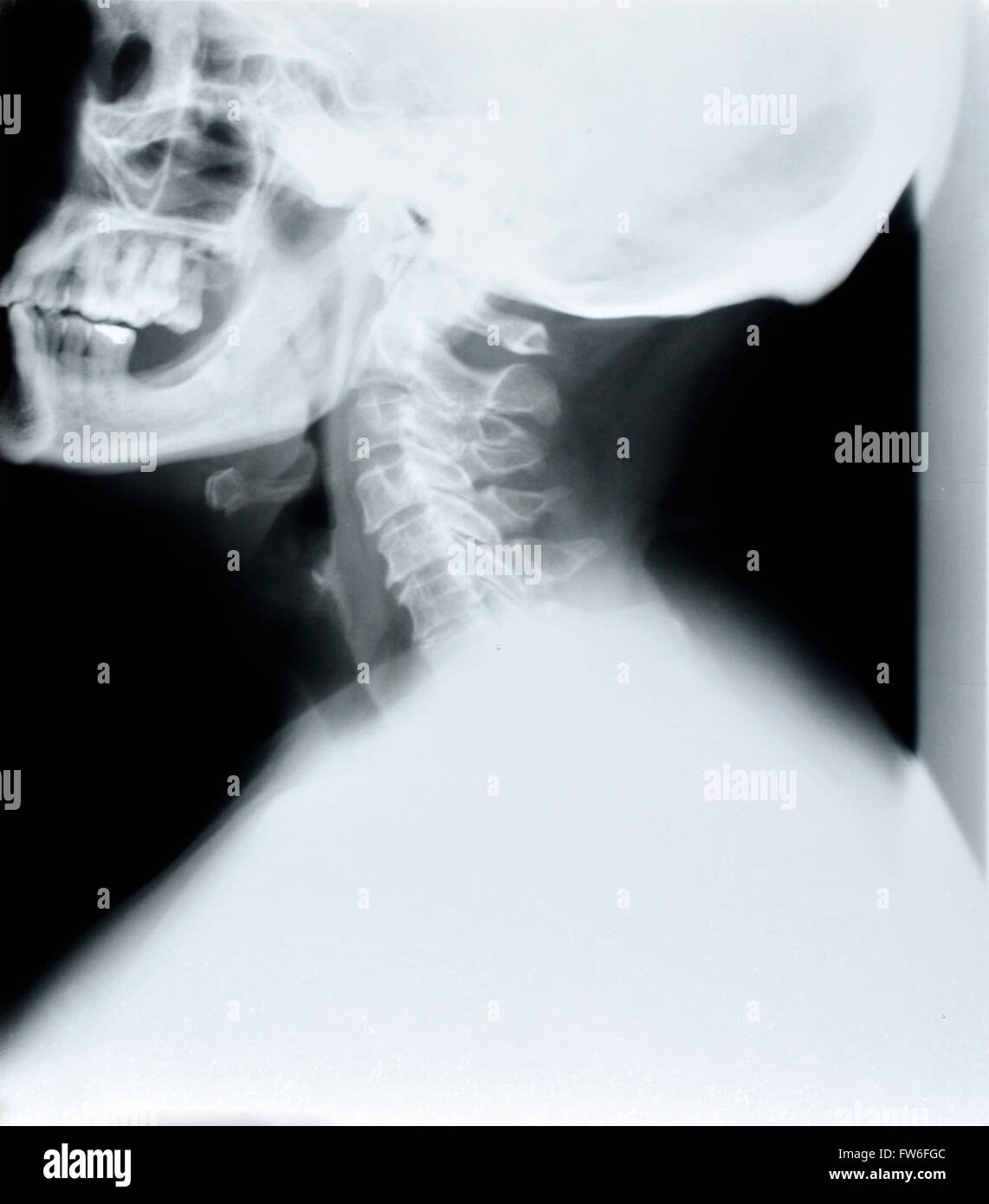 Detail von Hals und Kopf Röntgenbild Stockfoto