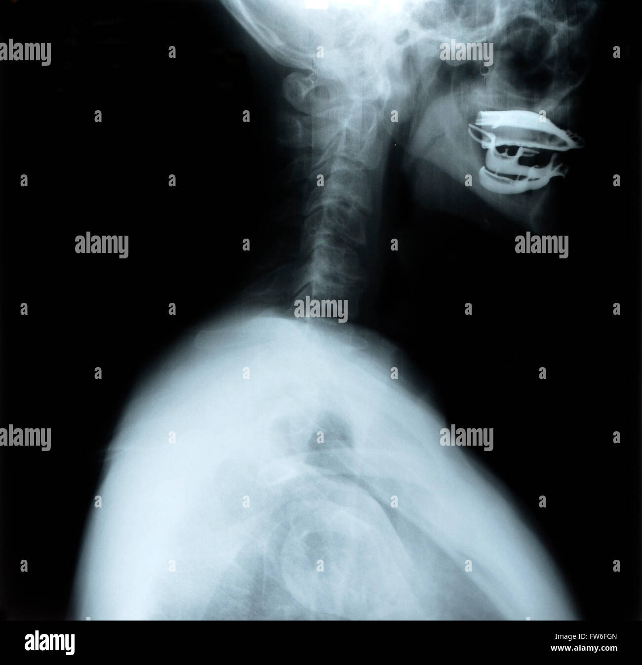 Detail von Hals und Kopf Röntgenbild Stockfoto