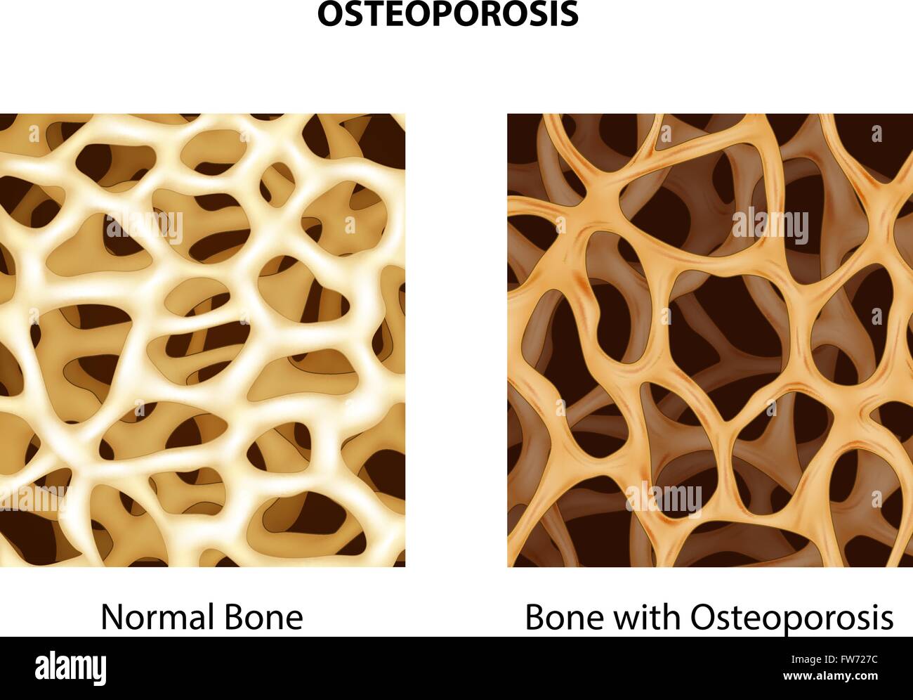 Darstellung der normalen Knochen und Knochen mit Osteoporose Stock Vektor