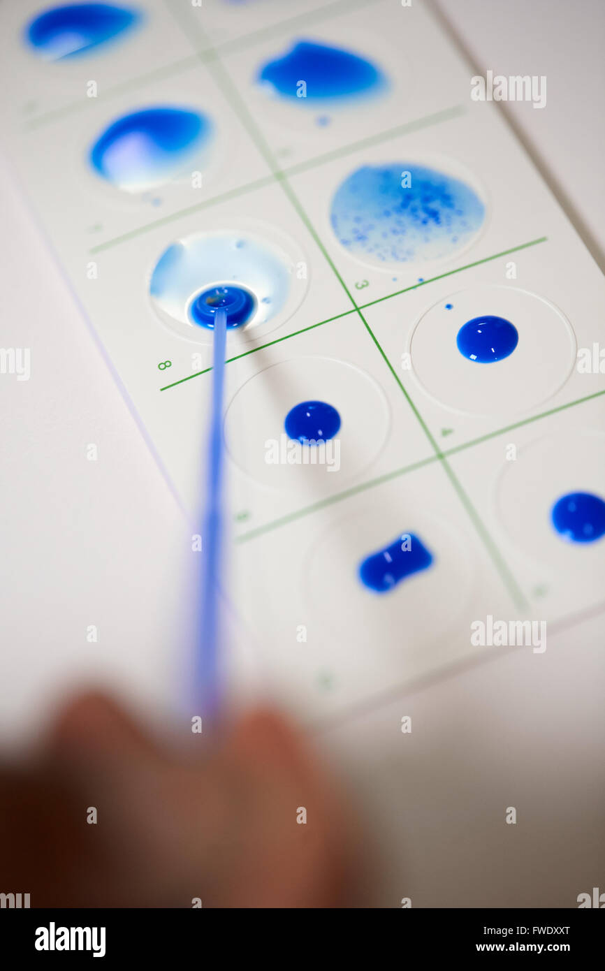 positive Testergebnisse Fieber Karte blau Mononukleose Tests Bluttests sind zu Antikörpern suchen, die angeben, Mononukleose Stockfoto