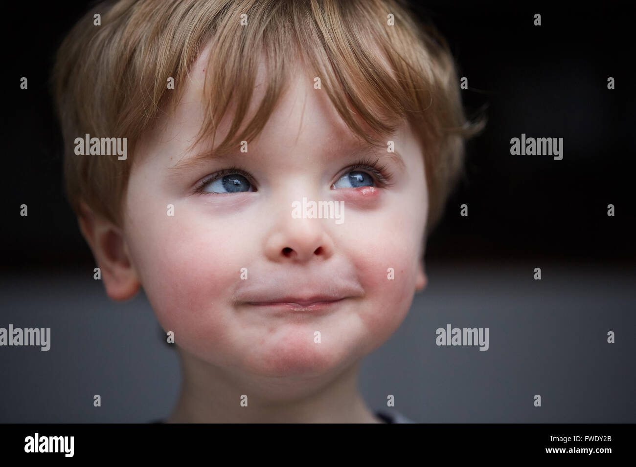 Eine externe Gerstenkorn oder Gerstenkorn Hordeolum, ist auch eine Infektion der Talgdrüsen der Zeis an der Basis der Wimpern oder eine Infe Stockfoto