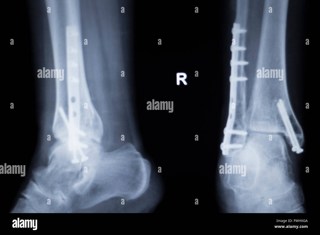 Knöchel und Bein Verletzungen medizinische Röntgen-Scan Testergebnis für  Erwachsene zeigt orthopädische Traumatologie Titan Metallplatte und  Schrauben-Implantat-Bild Stockfotografie - Alamy