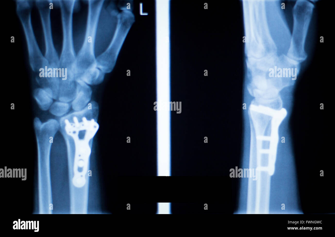 Platte Aus Handgelenk Entfernen Wie Lange Krank Handgelenk, hand, Unterarm und Verletzungen medizinische Röntgen-Scan