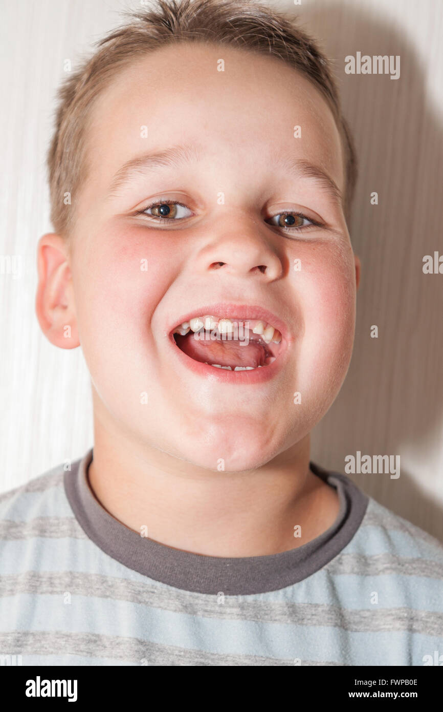 kleiner Junge mit einer zerrissenen vorderen ersten Milchzahn Stockfoto