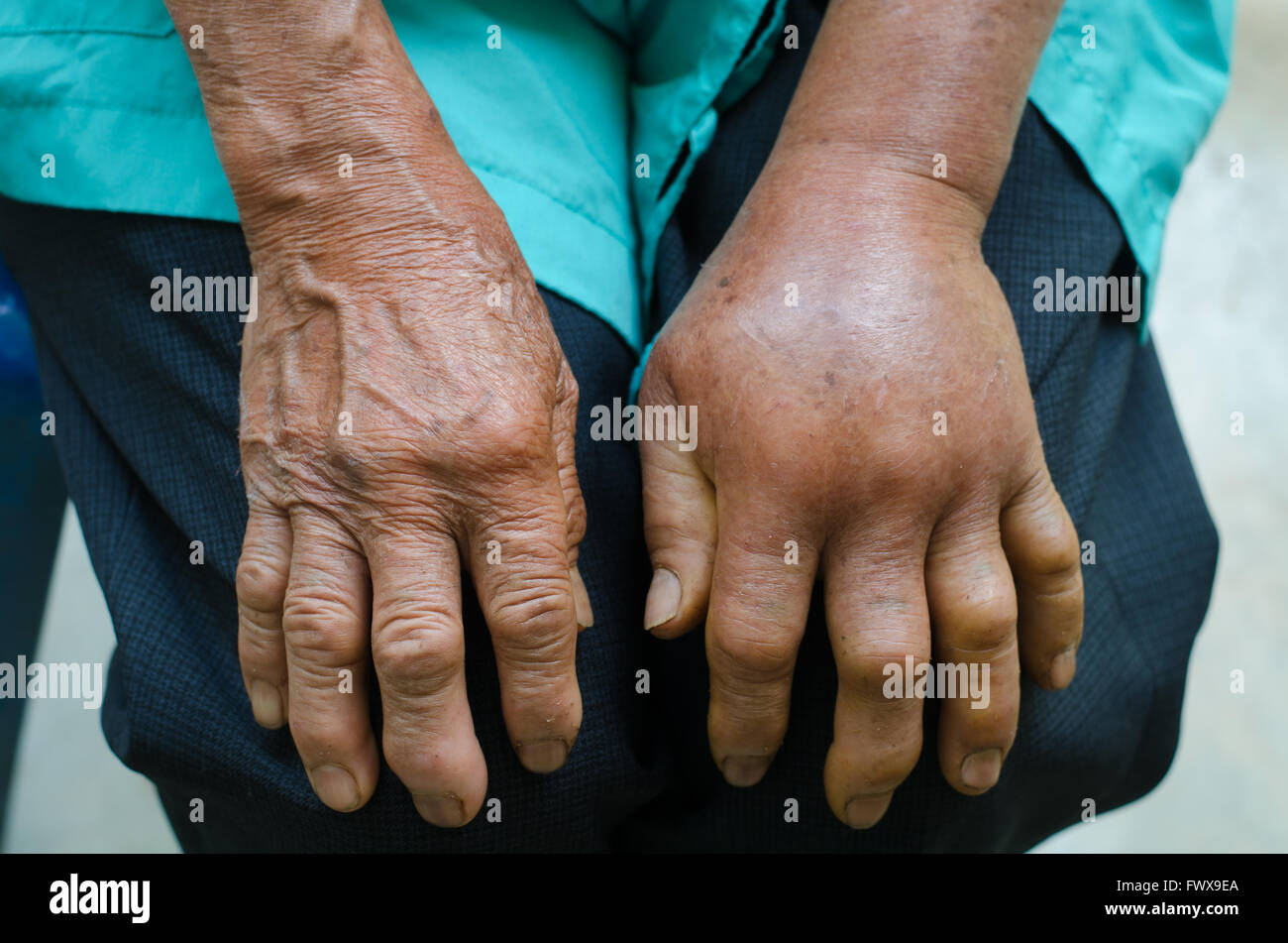 Entzündung der linken Hand vom grünen Grube Viperb Schlangenbiss Stockfoto